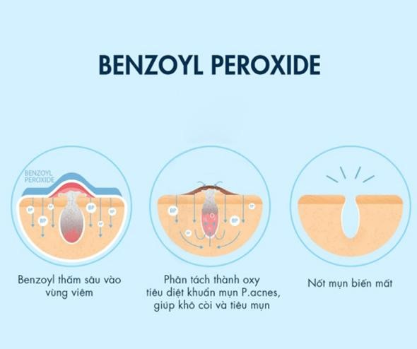 Benzoyl Peroxide là gì? Tại sao sử dụng Benzoyl Peroxide trị mụn lại cho  kết quả vượt trội?