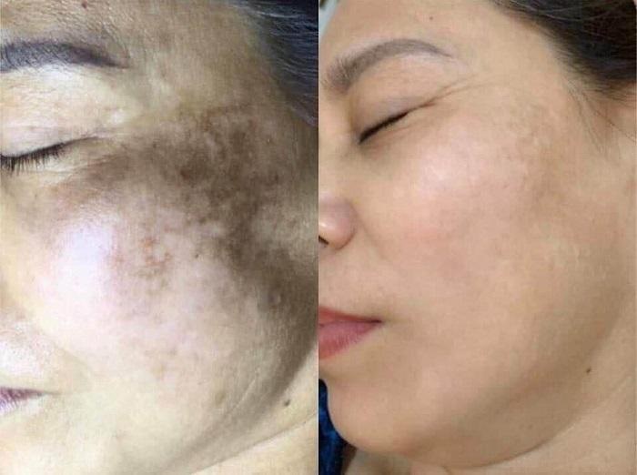 Kem trị nám Image MD chứa nhiều thành phần đặc trị nám và chống oxy hóa