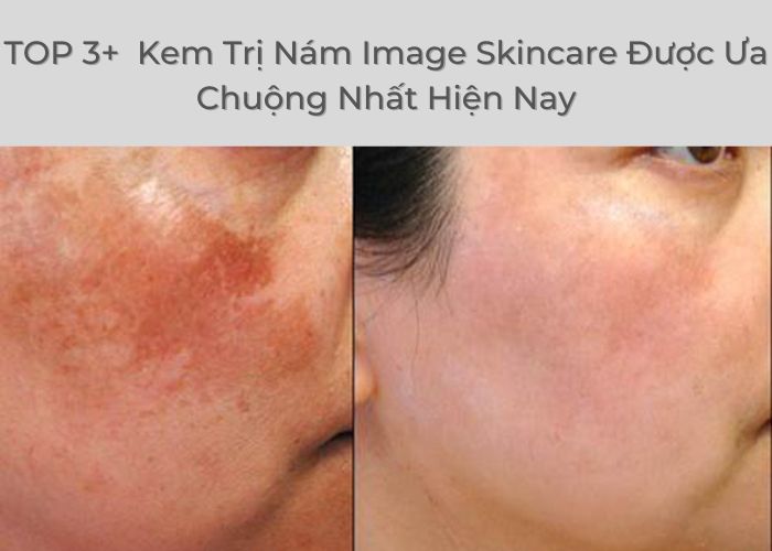 TOP 3+ Serum Trị Nám Image Skincare Được Ưa Chuộng Nhất Hiện Nay